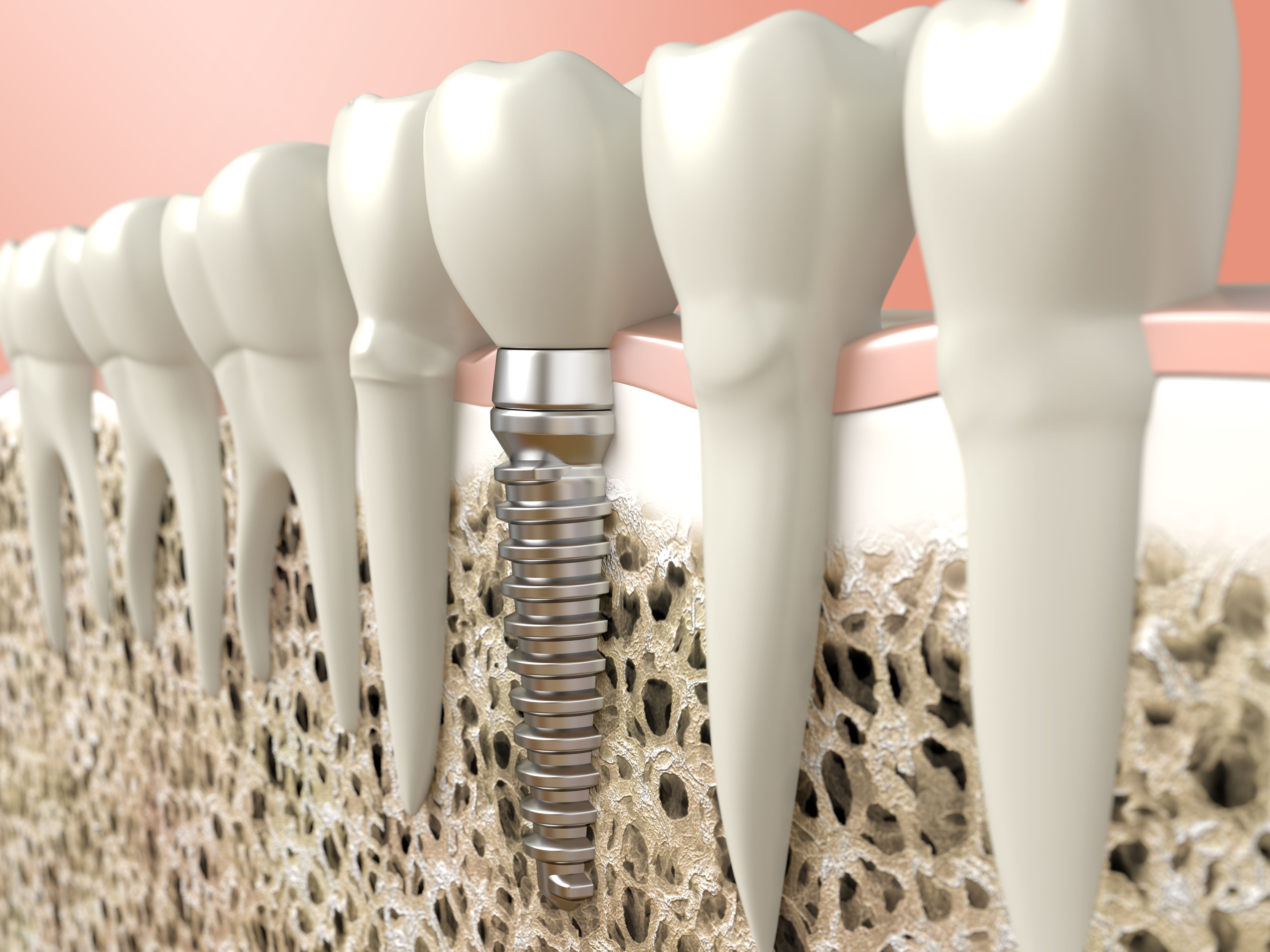 osseointegration, dental implants